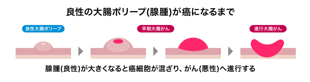 大腸がん