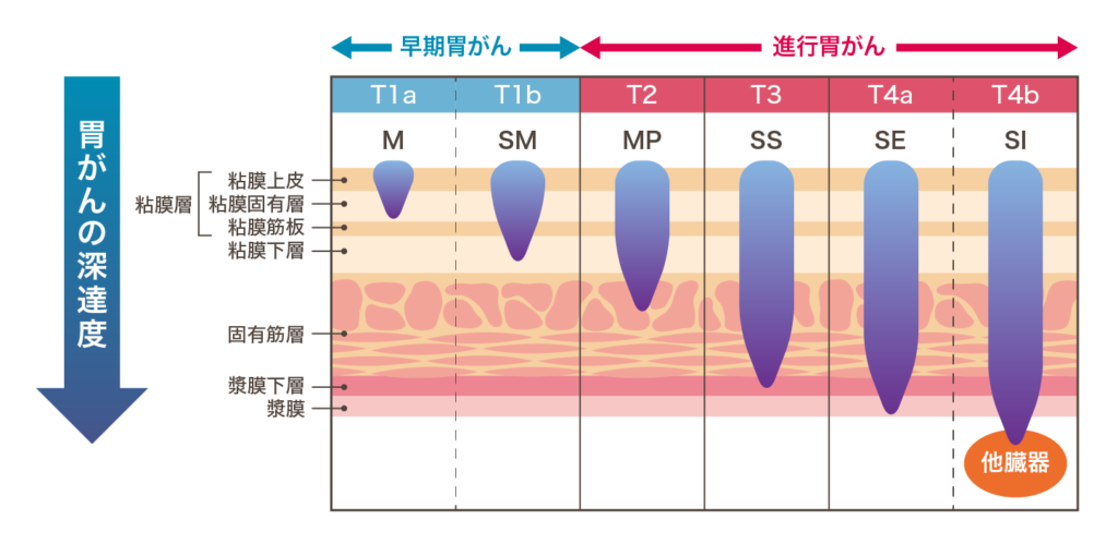 胃がん